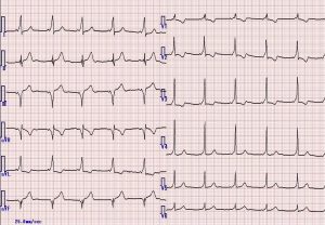 ECG