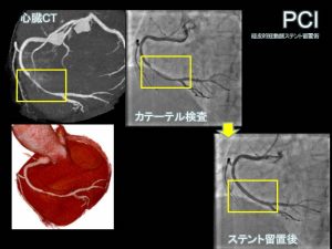 心臓CTとカテ治療前後の画像