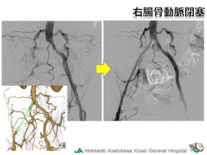 右腸骨動脈閉塞