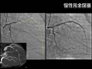 慢性完全閉塞