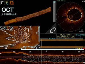 図2.ステント留置後の光干渉断層法検査の画像