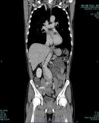 胸腹部CT　冠状断