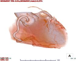 心臓CT　3D画像