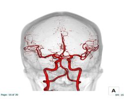 脳動脈CT　3D画像