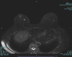 乳腺MRI
