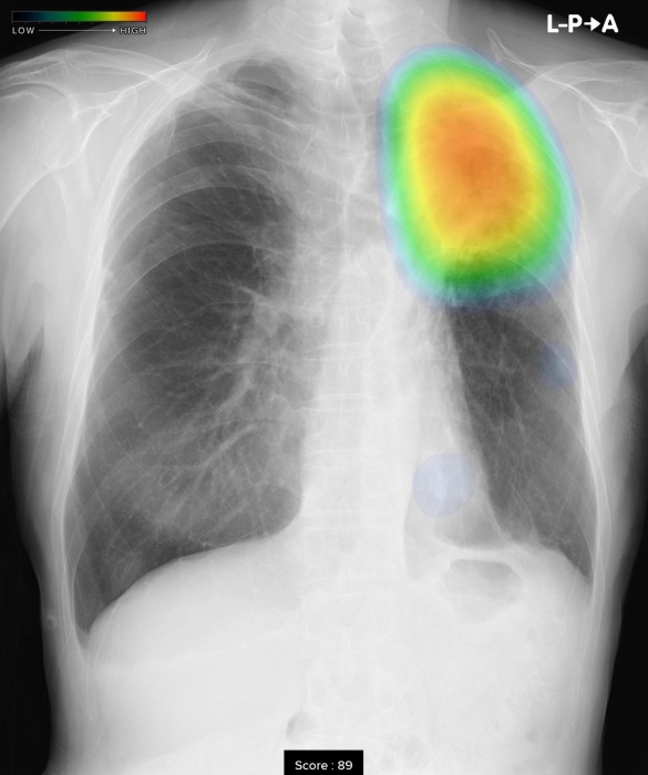 CXR-AIDを使用した 胸部単純X線画像