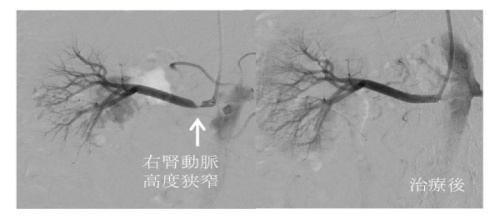 腎動脈狭窄症