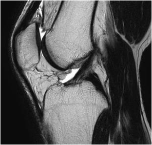 膝関節T2WI