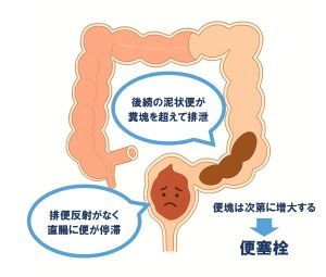 便塞栓の図解