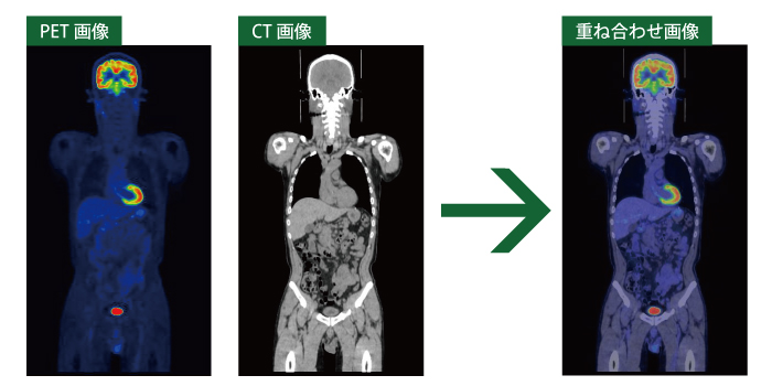 PETCT検査