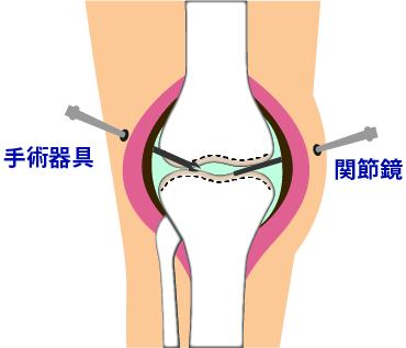 関節鏡手術