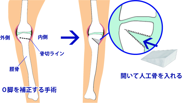 骨切り術(関節温存手術)