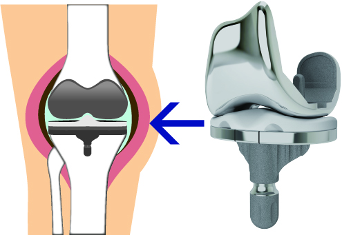 人工関節手術