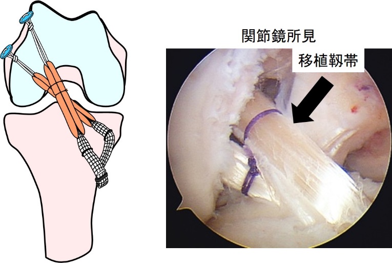 膝靱帯手術の全て