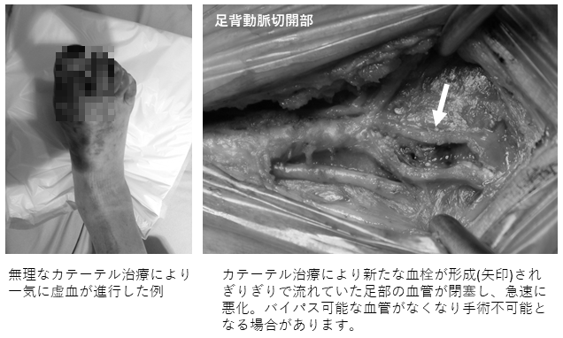 カテーテル治療失敗例写真