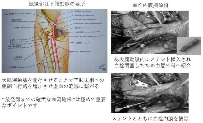 血栓内膜摘除