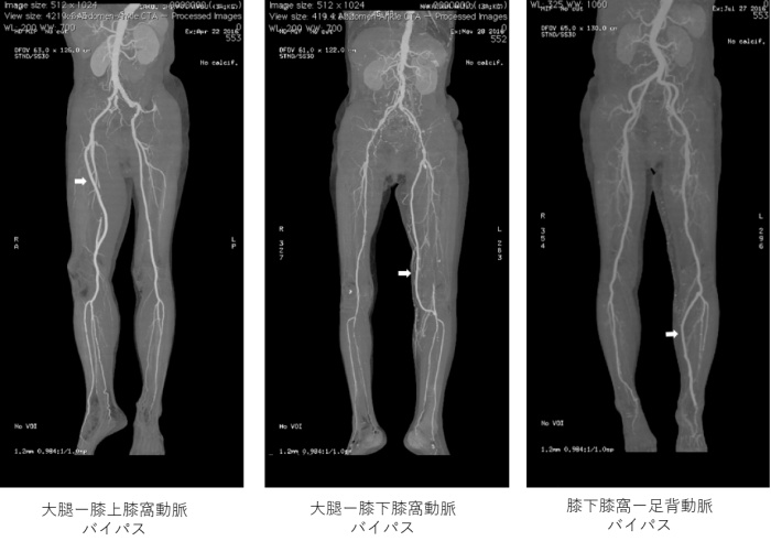 バイパス例血管造影写真説明入り