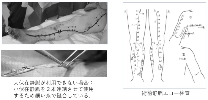 静脈グラフト写真と採取場所図