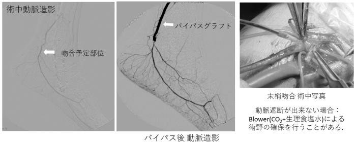 静脈吻合部位