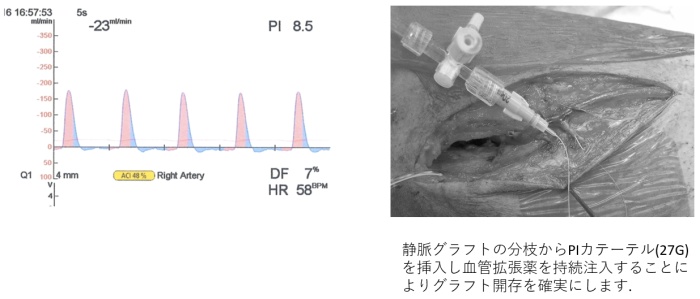 血管グラフト