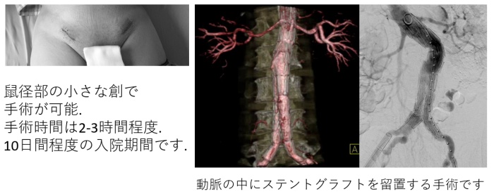 ステントグラフト留置術