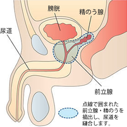 前立腺および骨盤内解剖図