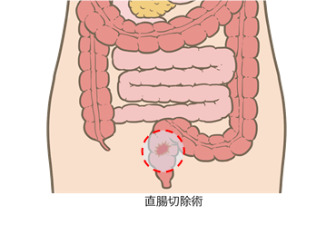 直腸切除術