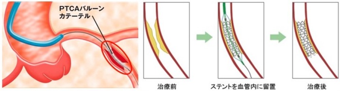 冠動脈ステント留置術画像