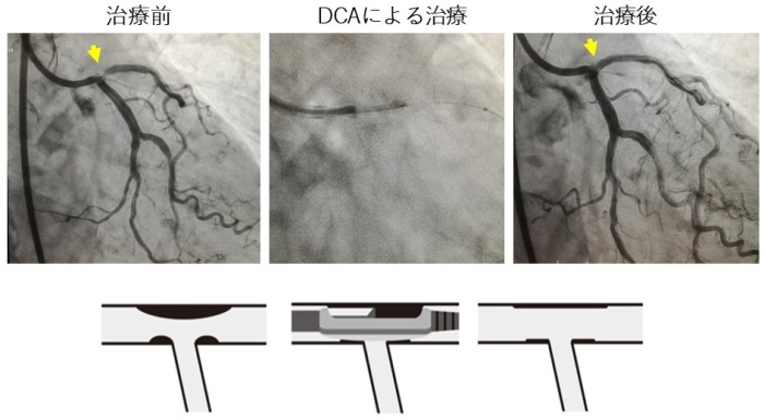 DCA（方向性冠動脈プラーク切除術）画像
