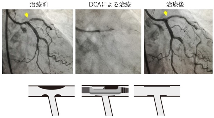 DCA(方向性冠動脈プラーク切除術)画像