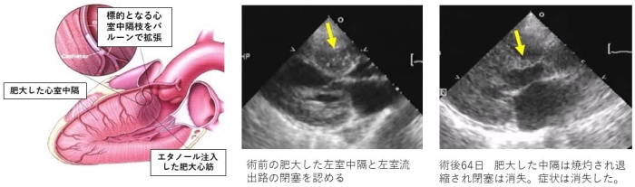 PTSMA（経皮的左室中隔心筋焼灼術）画像