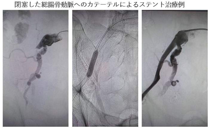 末梢血管カテーテル治療画像