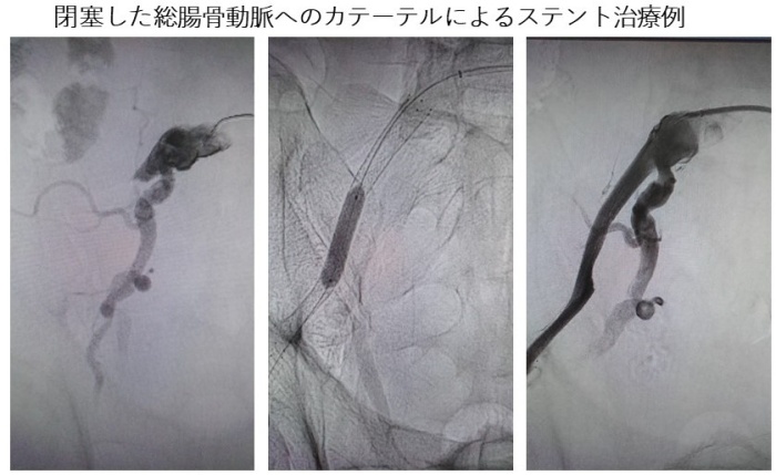 末梢血管カテーテル治療画像