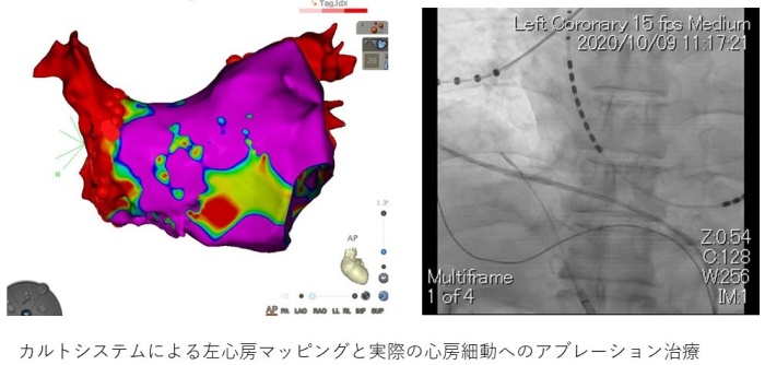 不整脈に対するカテーテル焼灼術（アブレーション）治療画像