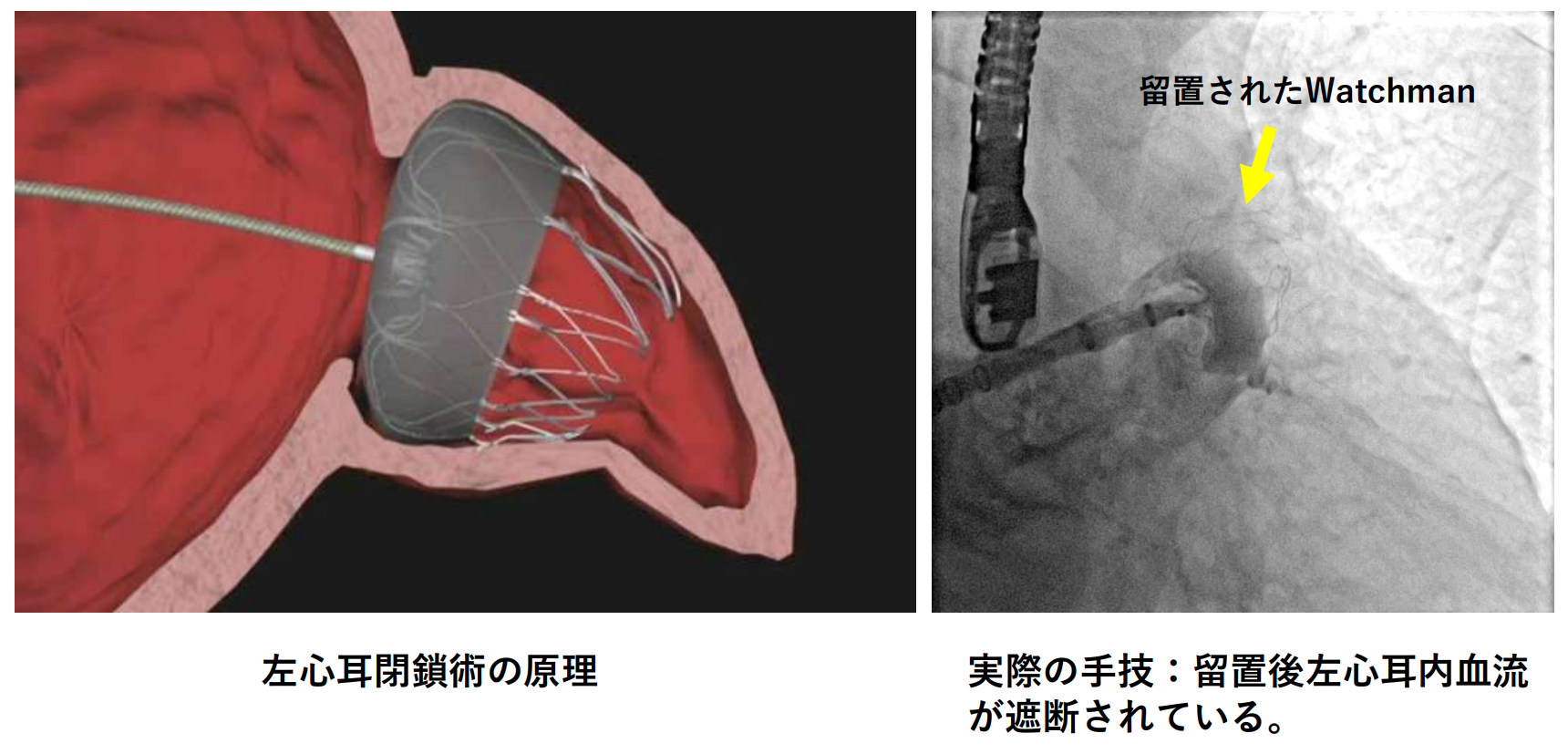 左心耳閉鎖術(径カテーテル)画像