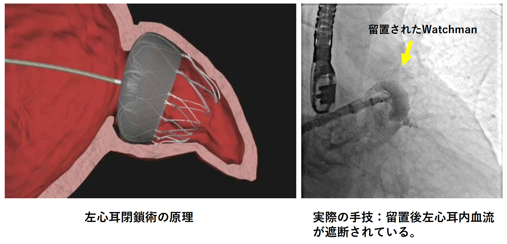 左心耳閉鎖術（径カテーテル）画像