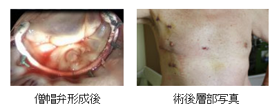 腹腔鏡を用いた僧帽弁形成術