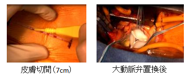 低侵襲大動脈弁手術