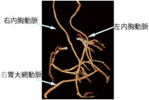 動脈グラフトを多用した冠動脈バイパス術