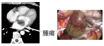 心臓腫瘍に対する胸腔鏡を用いた低侵襲手術