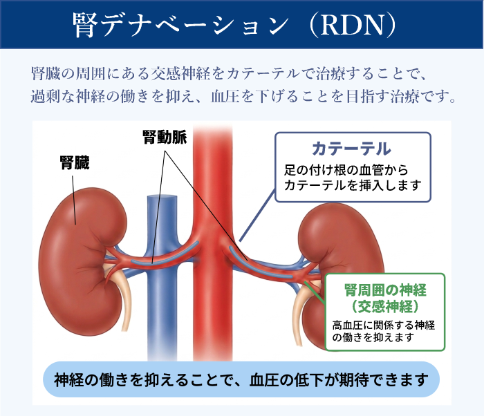 腎デナベーションとは、腎臓の周囲にある交感神経をカテーテルで治療することで、 過剰な神経の働きを抑え、血圧を下げることを目指す治療です。