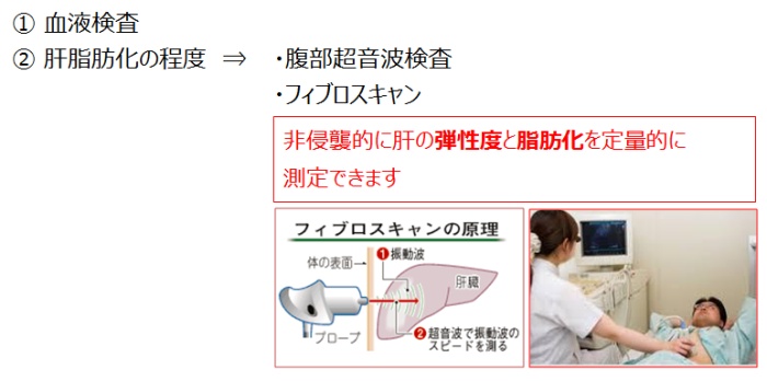 フィブロスキャン