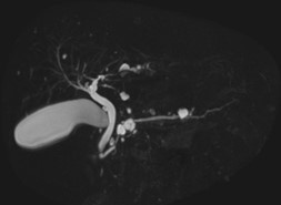 胆管膵管MRI画像