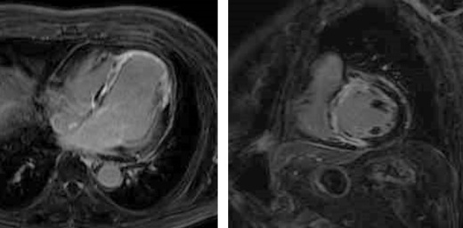 心臓MRI画像