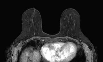 乳腺MRI画像