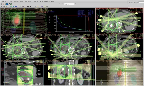 放射線治療計画の画像