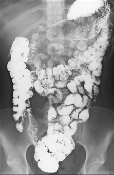 小腸X線検査画像