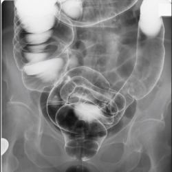 注腸X線検査画像