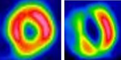 心筋シンチグラフィ画像左が正常、右が異常